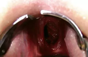 ડબલ ગુદા પ્રોબ અંતર